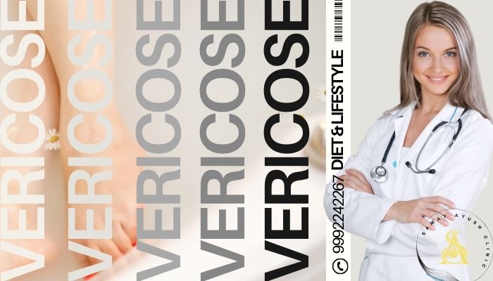 Varicose Veins - Diet & Lifestyle.